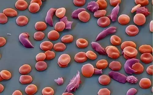 早期基因治疗数据有望治疗镰状细胞贫血