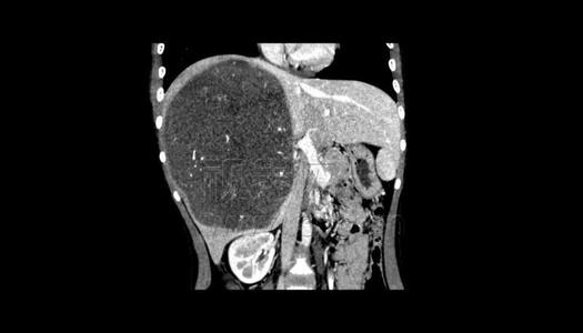 研究表明全息技术在肝肿瘤消融中的可行性