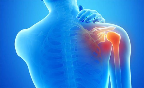 微创治疗的肩周炎可改善患者的疼痛和功能