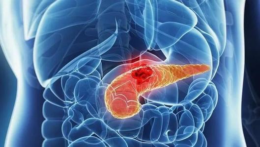 早期临床试验测试胰腺癌的治疗策略